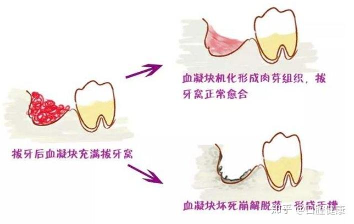 牙齿上有血块怎么办